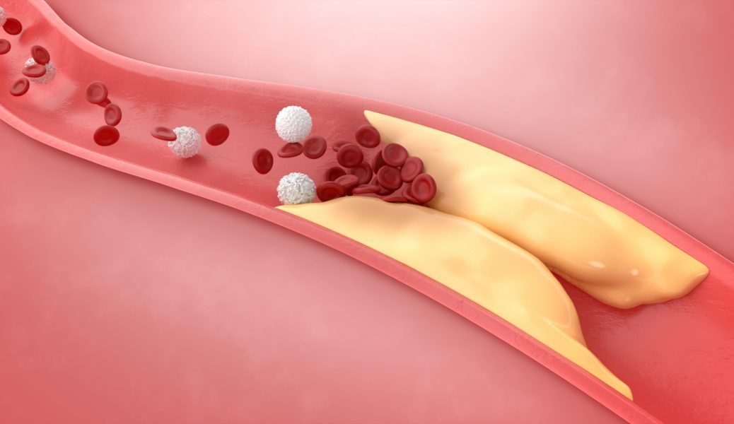 Vysoká hladina cholesterolu je rizikovým faktorem cévní mozkové příhody