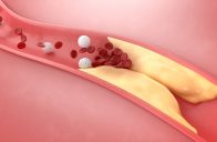 Vysoká hladina cholesterolu je rizikovým faktorem cévní mozkové příhody