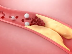 Vysoká hladina cholesterolu je rizikovým faktorem cévní mozkové příhody