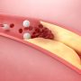 Vysoká hladina cholesterolu je rizikovým faktorem cévní mozkové příhody